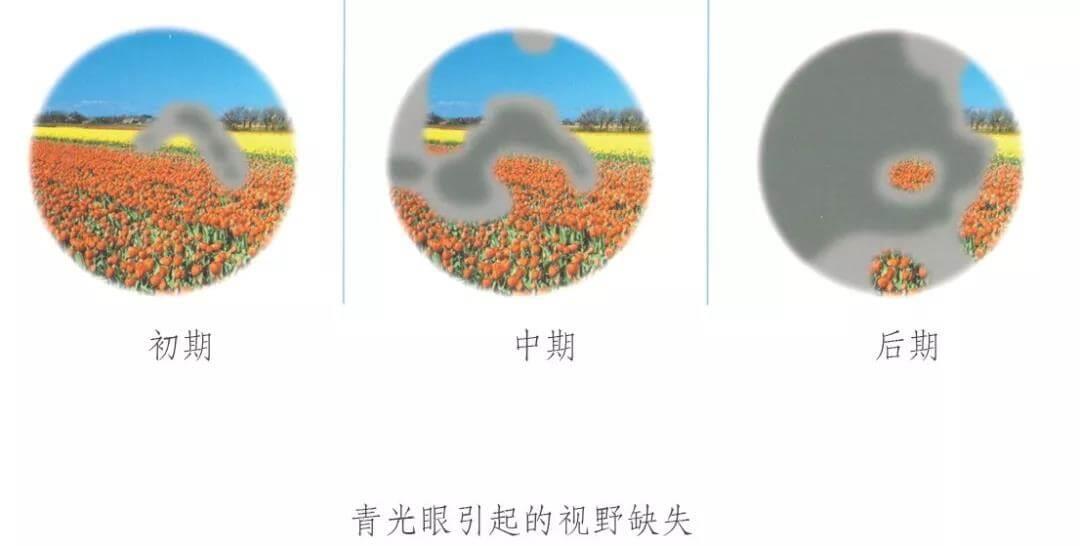 狗狗原发性闭角型青光眼手术治疗