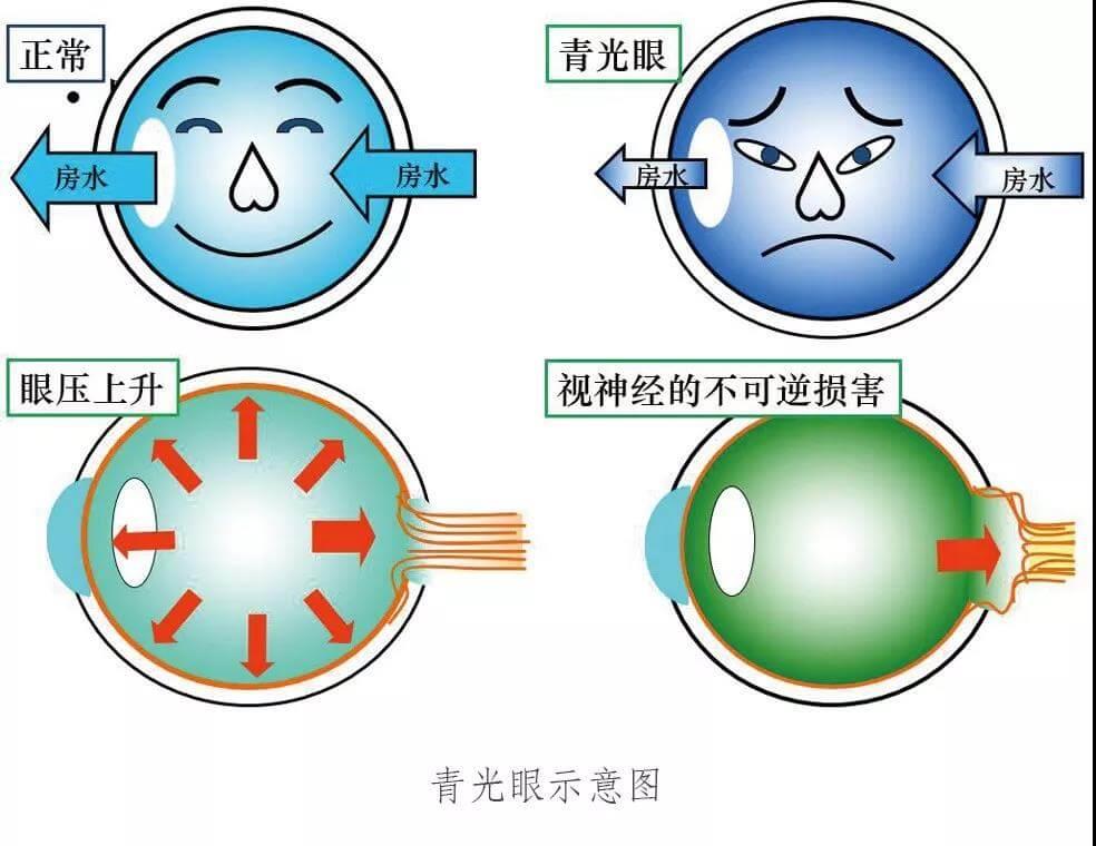 狗狗原发性闭角型青光眼手术治疗