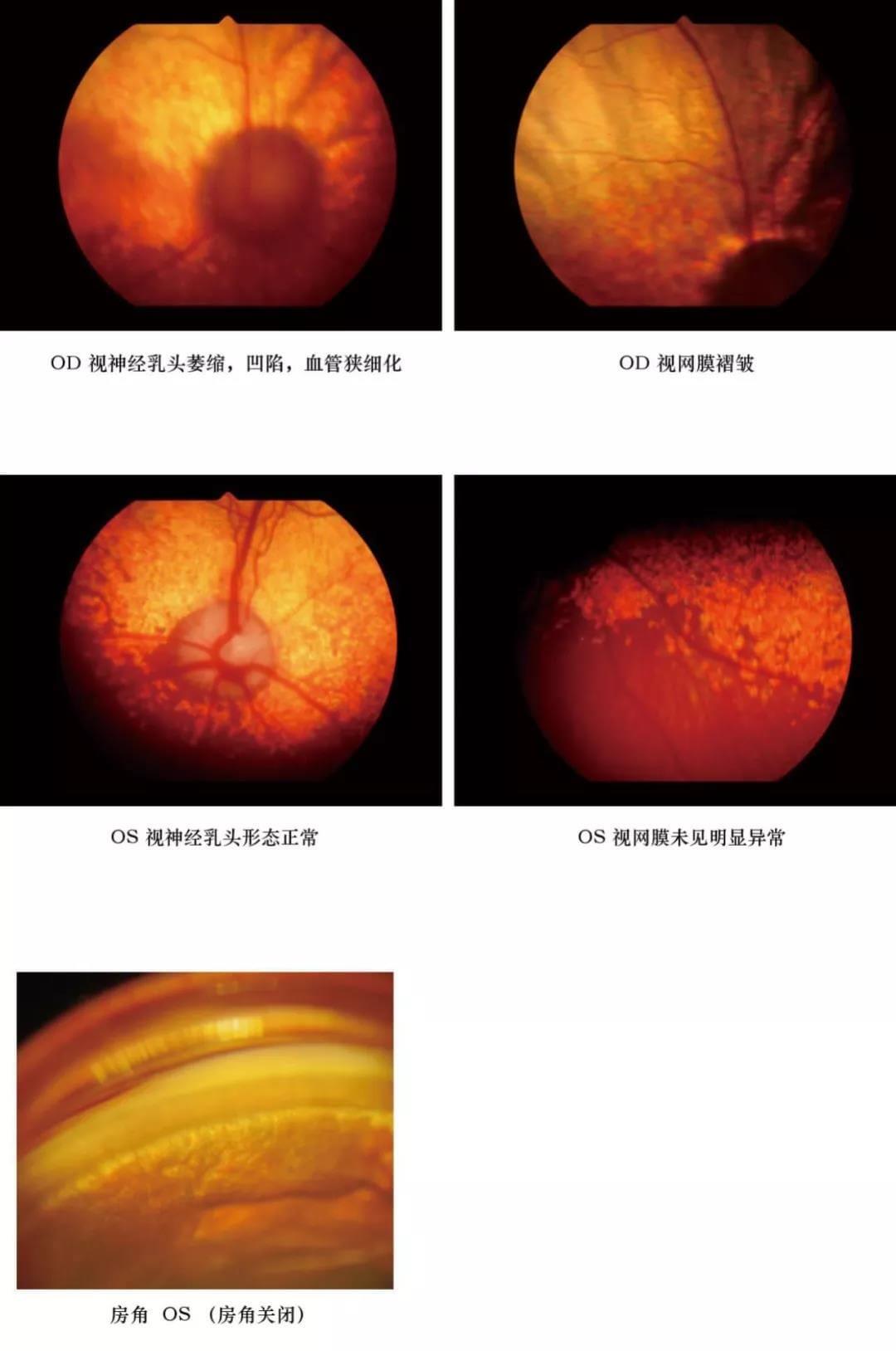 狗狗原发性闭角型青光眼手术治疗