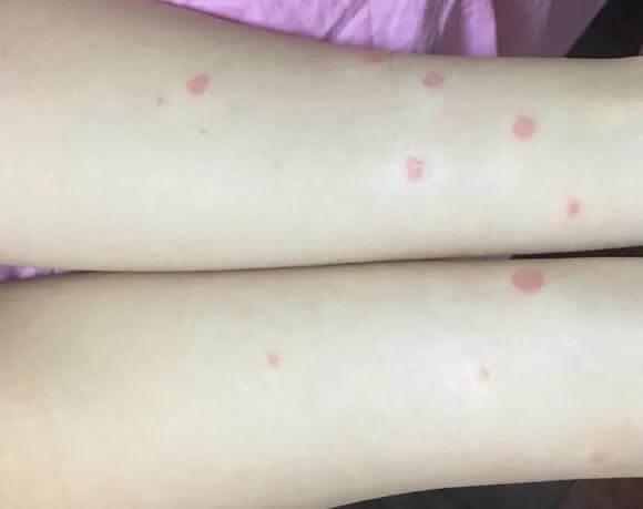 猫咪得了猫藓怎么办？猫藓又该如何预防？